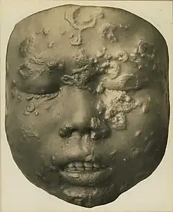 Secondary breakout in a 12-year-old Javanese child (wax model)