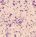 Peripheral blood stain of chronic myelogenous leukemia in accelerated phase (blast crisis)