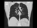 Chest CT (coronal lung window)