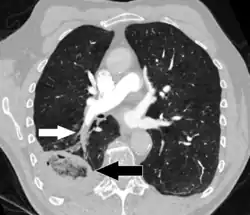 Pulmonary embolism (white arrow) that has been long-standing and has caused a lung infarction (black arrow) seen as a reverse halo sign
