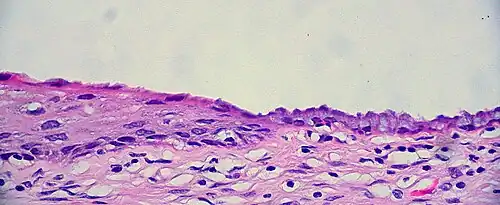The squamocolumnar junction of the cervix, with abrupt transition: The ectocervix, with its stratified squamous epithelium, is visible on the left. Simple columnar epithelium, typical of the endocervix, is visible on the right. A layer of connective tissue is visible under both types of epithelium.