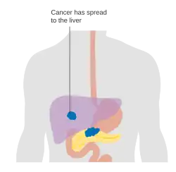 Metastasis – stage M1