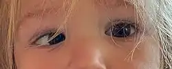 A child with accommodative esotropia affecting the right eye. The left eye points forwards while the right eye points inward towards the nose.