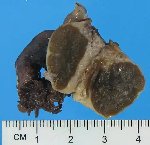 Typical gross pathology of a Leydig cell tumor (in this case of the ovary): A well circumscribed, solid homogeneous mass with golden brown to brownish green cut surface.[15]
