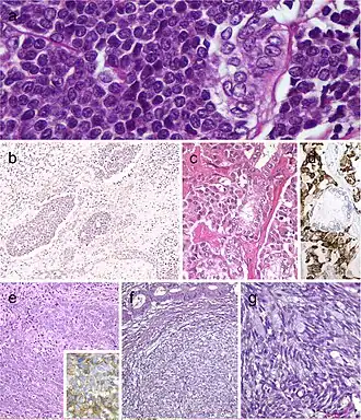 Carcinoma of the thyroid with Ewing family tumor elements (CEFTE) disclosing solid nests of small cells with regular, round nuclei, and nests of papillary thyroid carcinoma (PTC) (a). This case is from a 17-year-old female patient with bilateral involvement of the thyroid by a malignant thyroid teratoma (b); the tumor discloses nests of small cells, rich stroma with chondroid appearance and an epithelial-tubular component. Mixed medullary and papillary thyroid carcinoma (c); the medullary thyroid carcinoma component stained positively for calcitonin mRNA while the PTC (follicular variant) component was negative (d). Intrathyroid thymic carcinoma (ITC) also known by the acronym (CASTLE) showing positivity for CD5 (inset) (e). Spindle epithelial tumor with thymus-like differentiation (SETTLE) is a lobulated tumor composed of spindle cells and epithelioid cell component with glands, mucinous cysts, and/or squamous nests (f and g)[9]