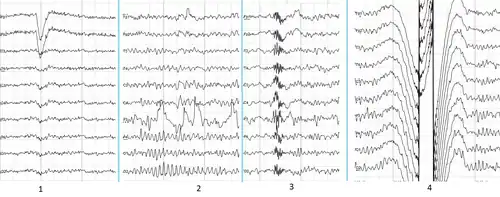 Main types of artifacts in human EEG
