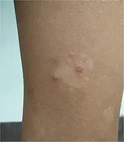 Secondary yaws begin as multiple small lesions.