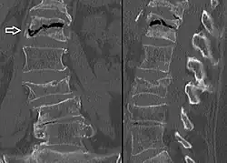 The intravertebral vacuum cleft sign (at white arrow) is a sign of avascular necrosis. Avascular necrosis of a vertebral body after a vertebral compression fracture is called Kümmel's disease.[20]