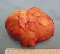 The resected lipoma (8 cm × 6 cm × 3 cm)