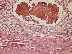 Inflammatory Infiltrate