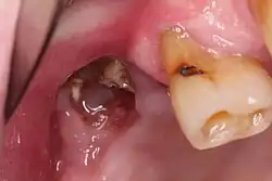 clinical photograph of MRONJ