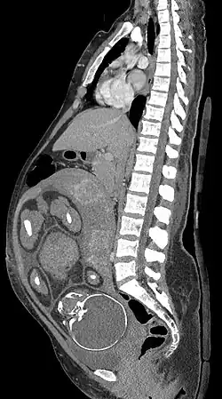 Median plane CT scan of a pregnant woman. The fetus (exposed in the coronal plane) is 37 weeks of gestational age.