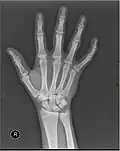 X-ray image of right hand with thumb on left.
