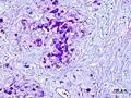 Histopathologic image of mucoepidermoid carcinoma. Postoperative recurrence of the submandibular tumor. Alcian blue-PAS stain