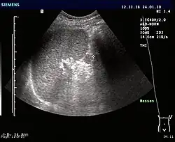Ultrasonography of an accessory spleen.