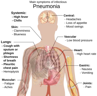 A diagram of the human body outlining the key symptoms of pneumonia