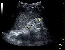 Figure 25. End-stage chronic kidney disease with increased echogenicity, homogenous architecture without visible differentiation between parenchyma and renal sinus and reduced kidney size. Measurement of kidney length on the US image is illustrated by '+' and a dashed line.[1]