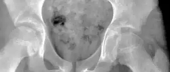 Figure 2C. AP view of a patient with left hip effusion secondary to trauma showing widening of the medial joint space.[1]