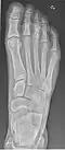 Normal right foot by dorsoplantar projection
