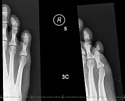 X-ray shows a small portion broken off the corner of the distal bone, and a [more longitudinal fracture in the bone in the middle of the toe?},